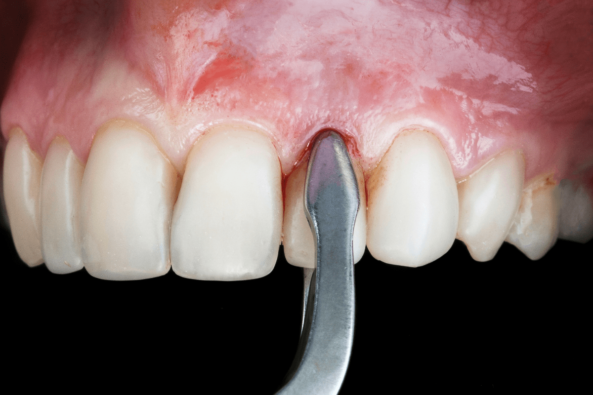 https://smilenshine.in2inglobal.co.in/wp-content/uploads/2025/04/Tooth-extractions-min.png